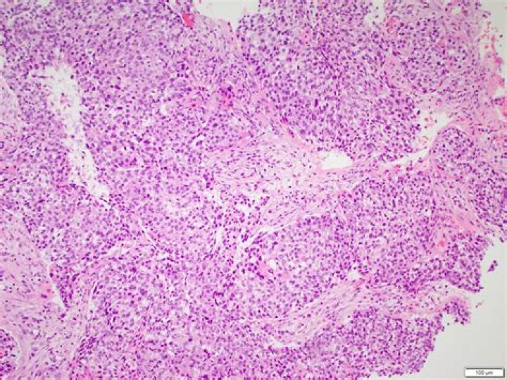 Jim Kelly Illness: NFL icon confronts a battle with squamous cell carcinoma in the upper jaw | A brave fight against cancer unfolds - SarkariResult